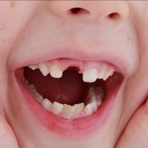 What Must Parents Do When a Child’s Tooth is Knocked Out?