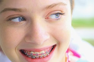 Pediatric Dental 101 : Braces and Their Types