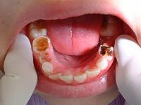 What causes dental cavities?