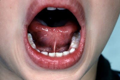 Tongue Tie and What it Does to Children?