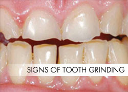 Bruxism – Teeth Grinding Isn’t Always Harmless