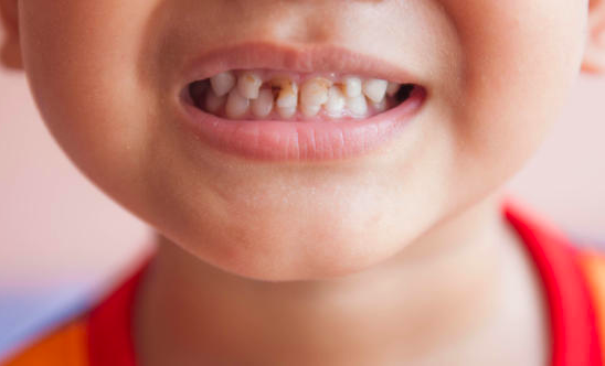 5 Stages of Dental Decay and Treatment