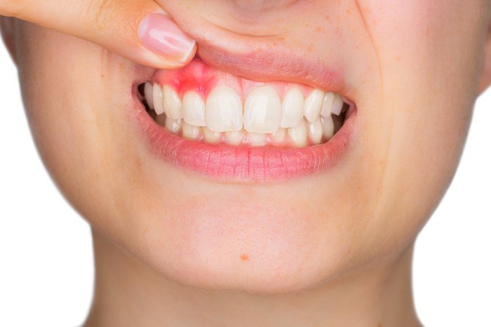 Does Your Child Have Gum Disease?