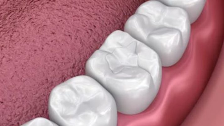 Dental Sealants – Effective option to help prevent cavities