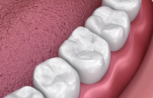 Dental Sealants - Effective option to help prevent cavities