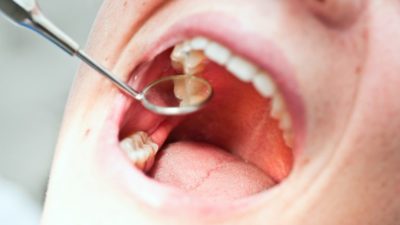 Ask A Dentist: Is Dental Decay Contagious?