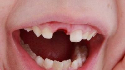 What to Do When Your Child’s Tooth Gets Knocked Out