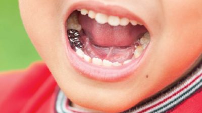 Ask A Dentist: When Do Baby Teeth Need Crowns?