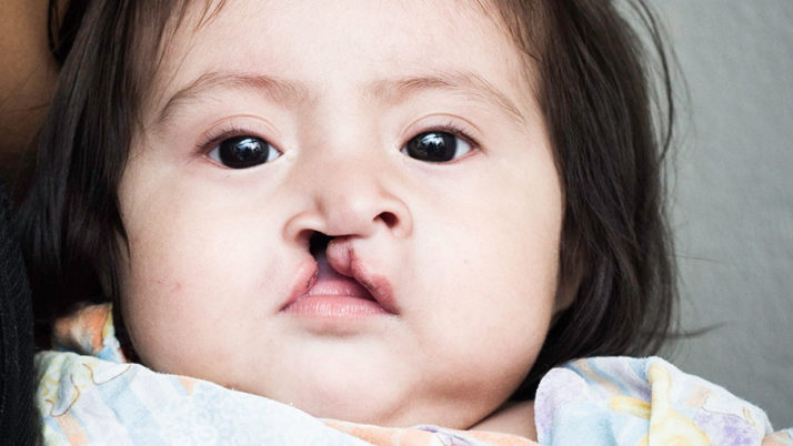 Cleft Lip and Cleft Palate in Children : All you need to know