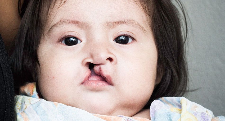 What You Need To Know About Your Childs Cleft Lip Anomaly Small Bites.