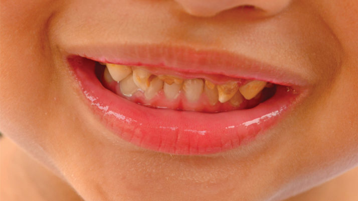 Bruxism in Children: What is it, Causes and Treatments