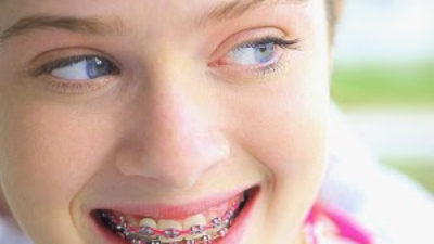 Types of Braces for Kids and Children
