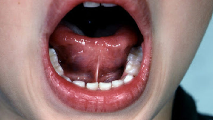 What is Tongue Tie (Ankyloglossia) – Symptoms and Treatment