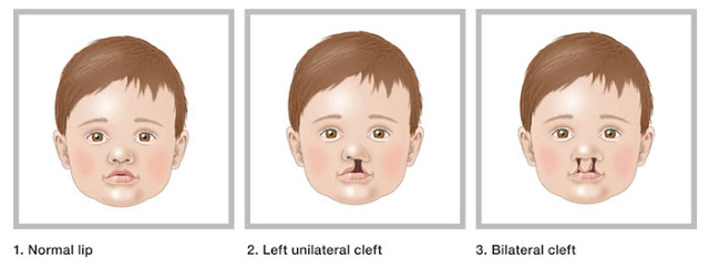 Cleft Lip and Cleft Palate in Children : All you need to know | Small Bites