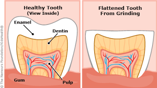 What are the side-effects of Bruxism?