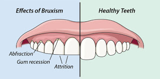 Teeth Grinding Or Bruxism Remains With Children Even As They Grow