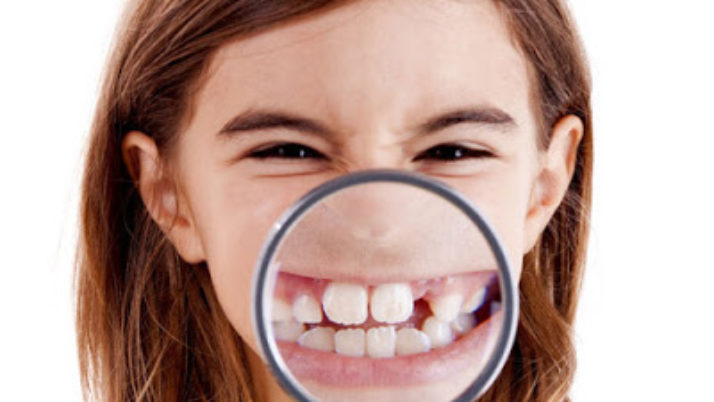Process of Dental Caries in Children