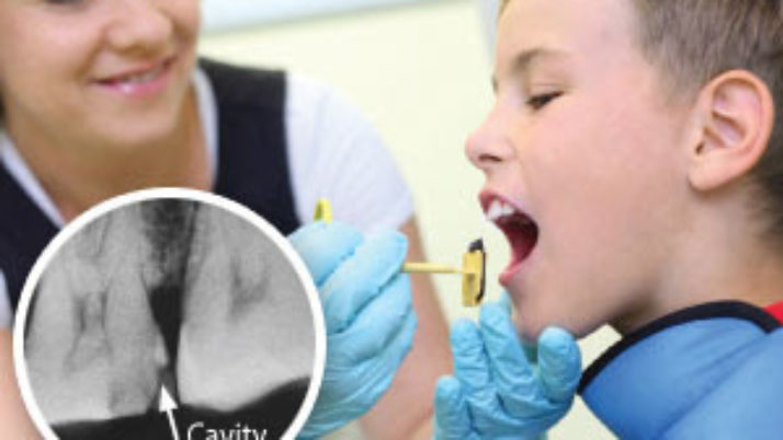 5 Common Types of Pediatric Dental X-ray Types