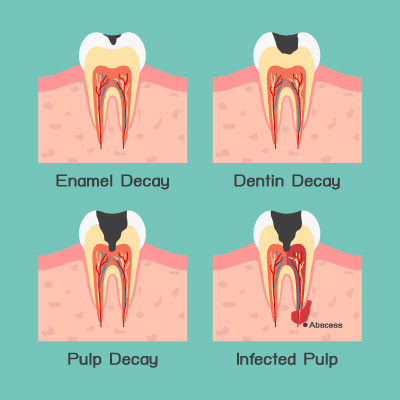 Process of Dental Caries in Children