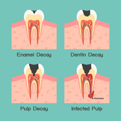 dental caries process