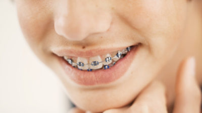 Correcting Children Teeth with Dental Braces : Type, Cost  & Procedure