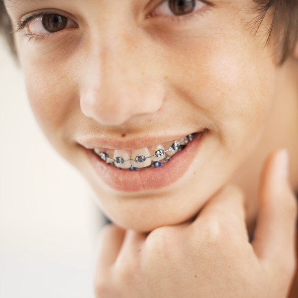 Correcting Teeth with Dental Braces : Type, Cost & Procedure in Bangalore