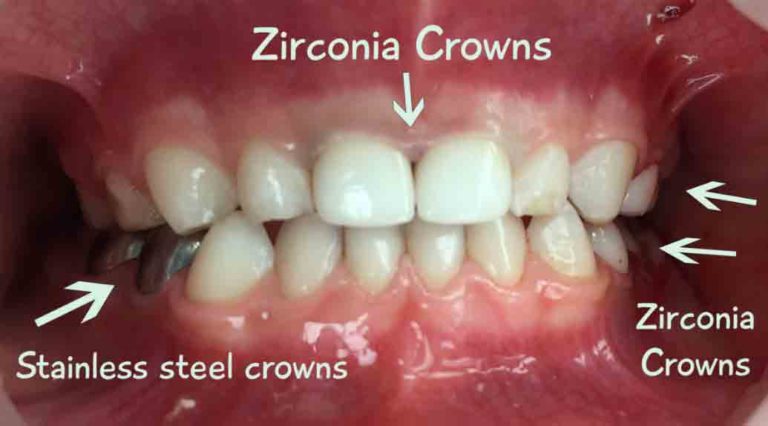 zirconia-dental-crowns-advantages-procedure-cost-small-bites