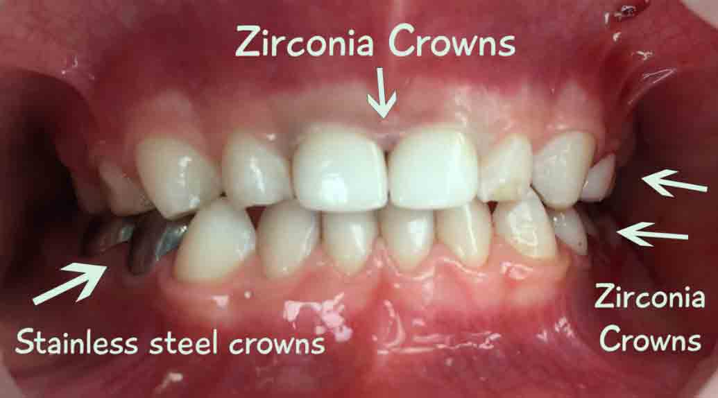 Zirconia Dental Crowns Advantages, Procedure, Cost Small Bites