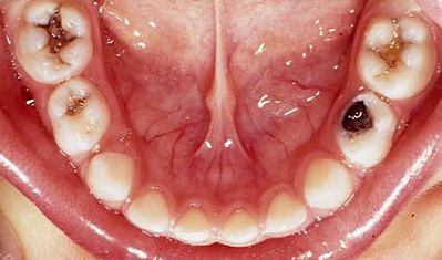 Molar Teeth Decay 