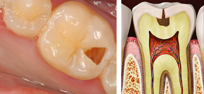 STAGE 3 - DECAY OF DENTIN