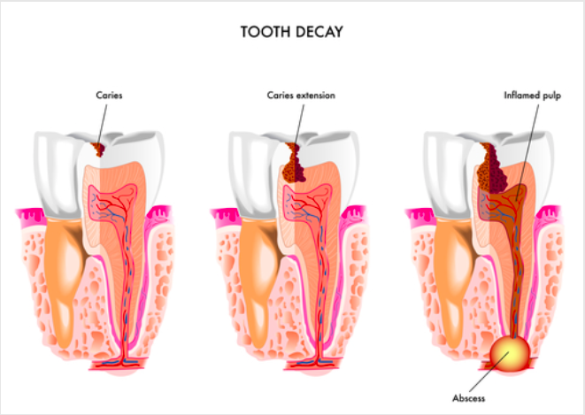 Understanding the 5 Stages of Tooth Decay & Treatment