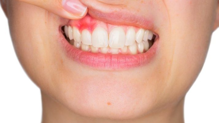 Gum Disease in Children: Symptoms and Treatments